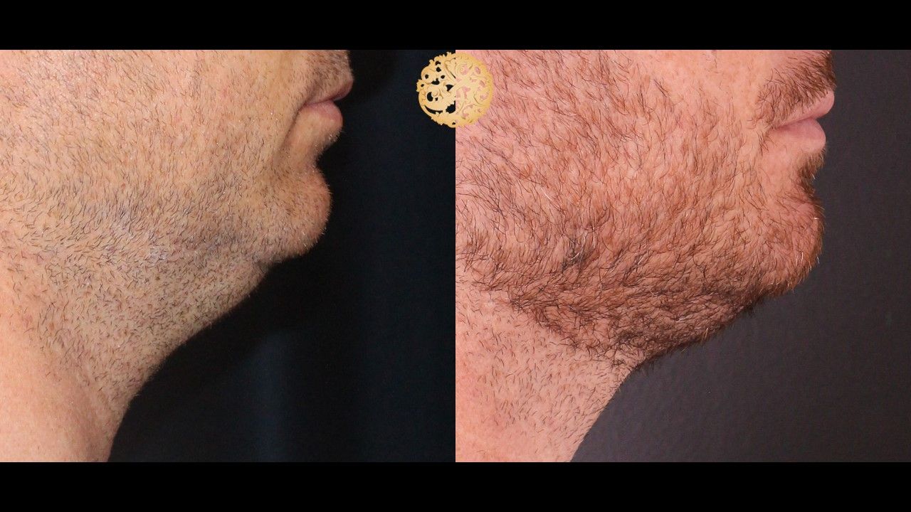 Face Liposuction Before & After