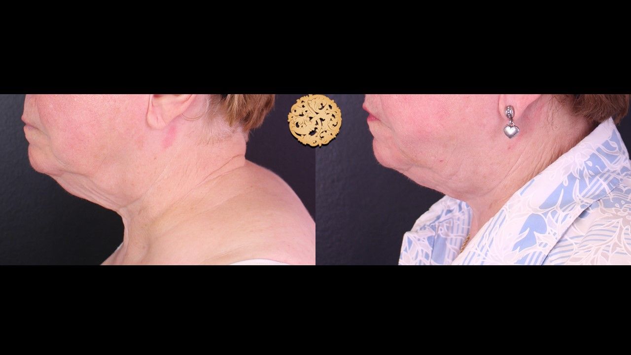 Face Liposuction Before & After