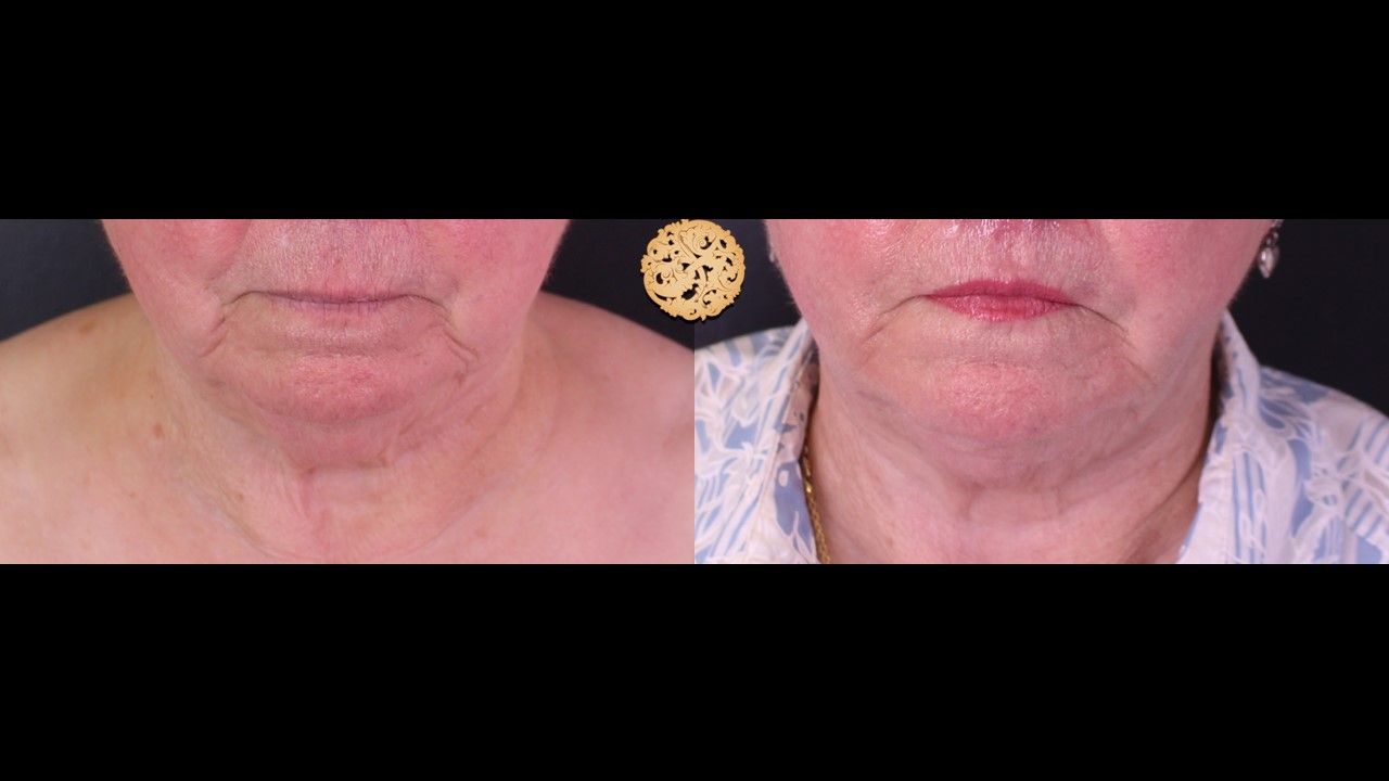 Face Liposuction Before & After