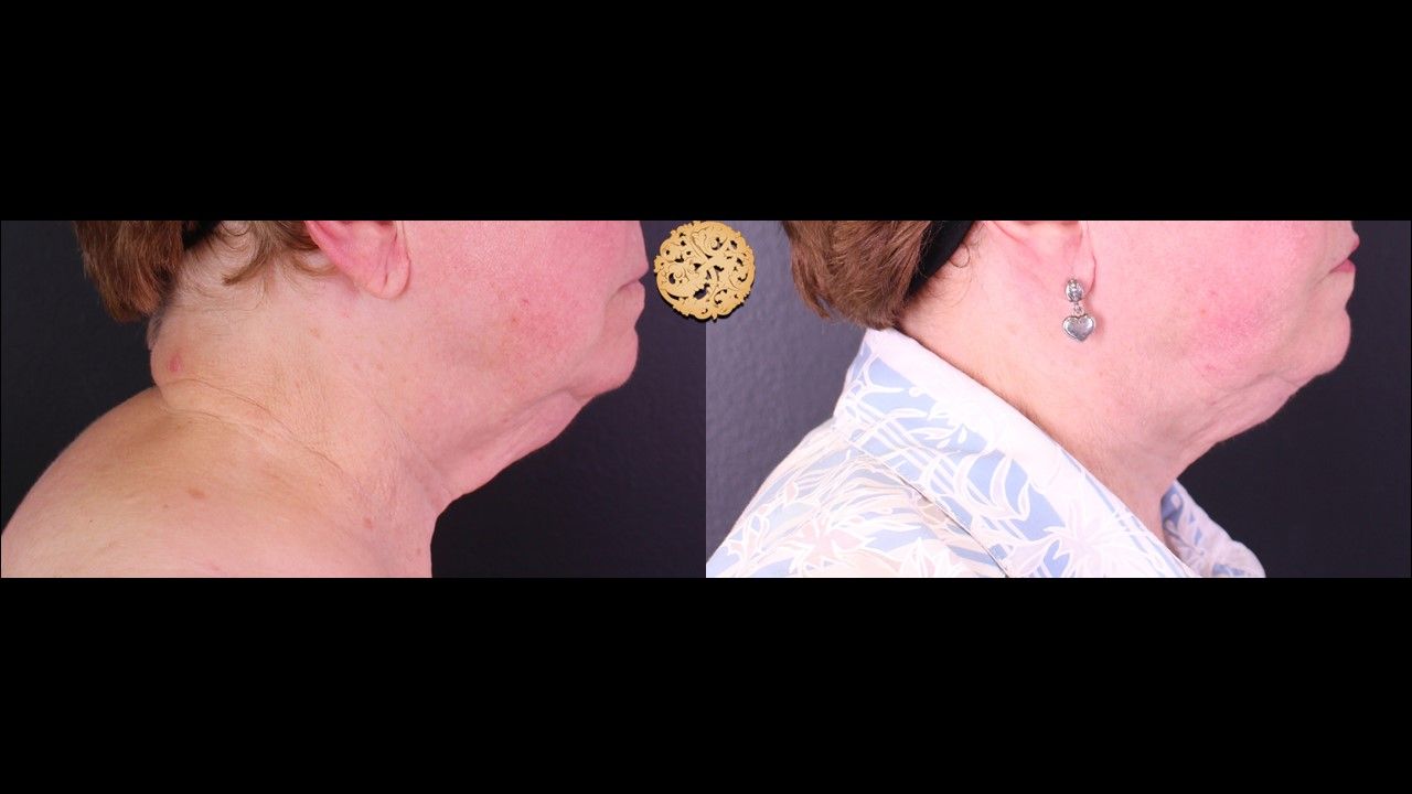 Face Liposuction Before & After