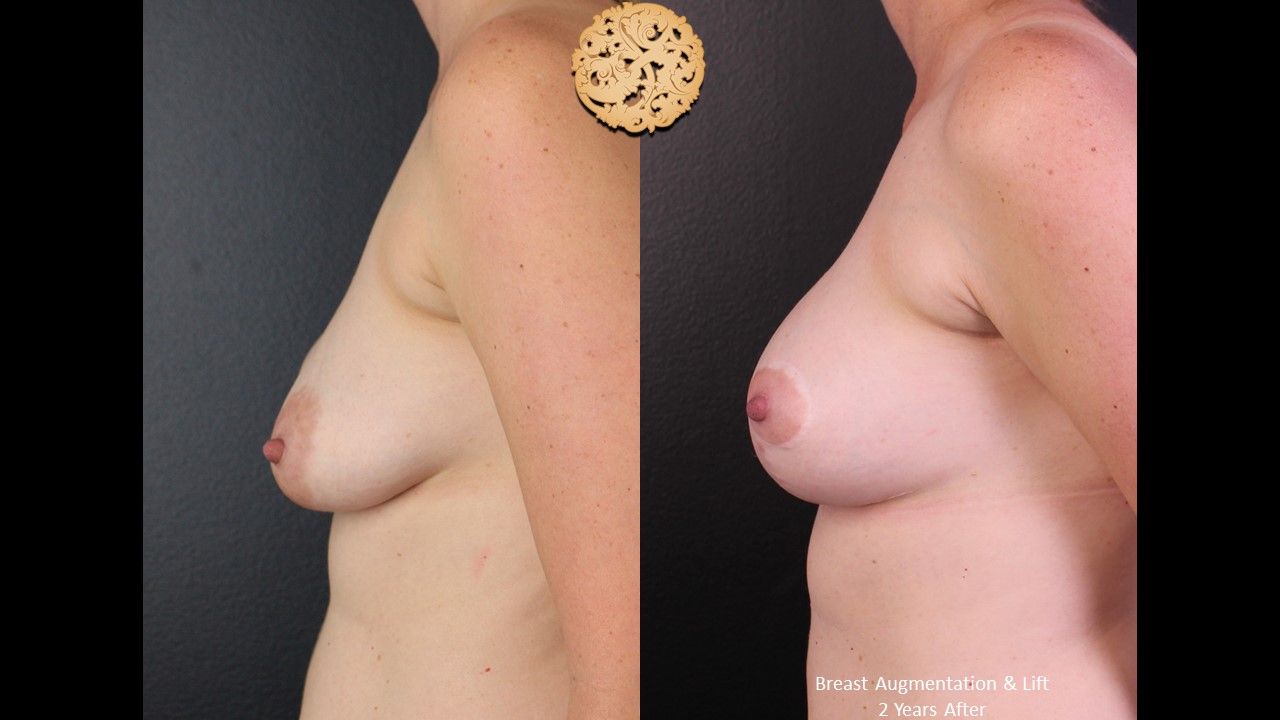Breast Augmentation With Lift Before & After