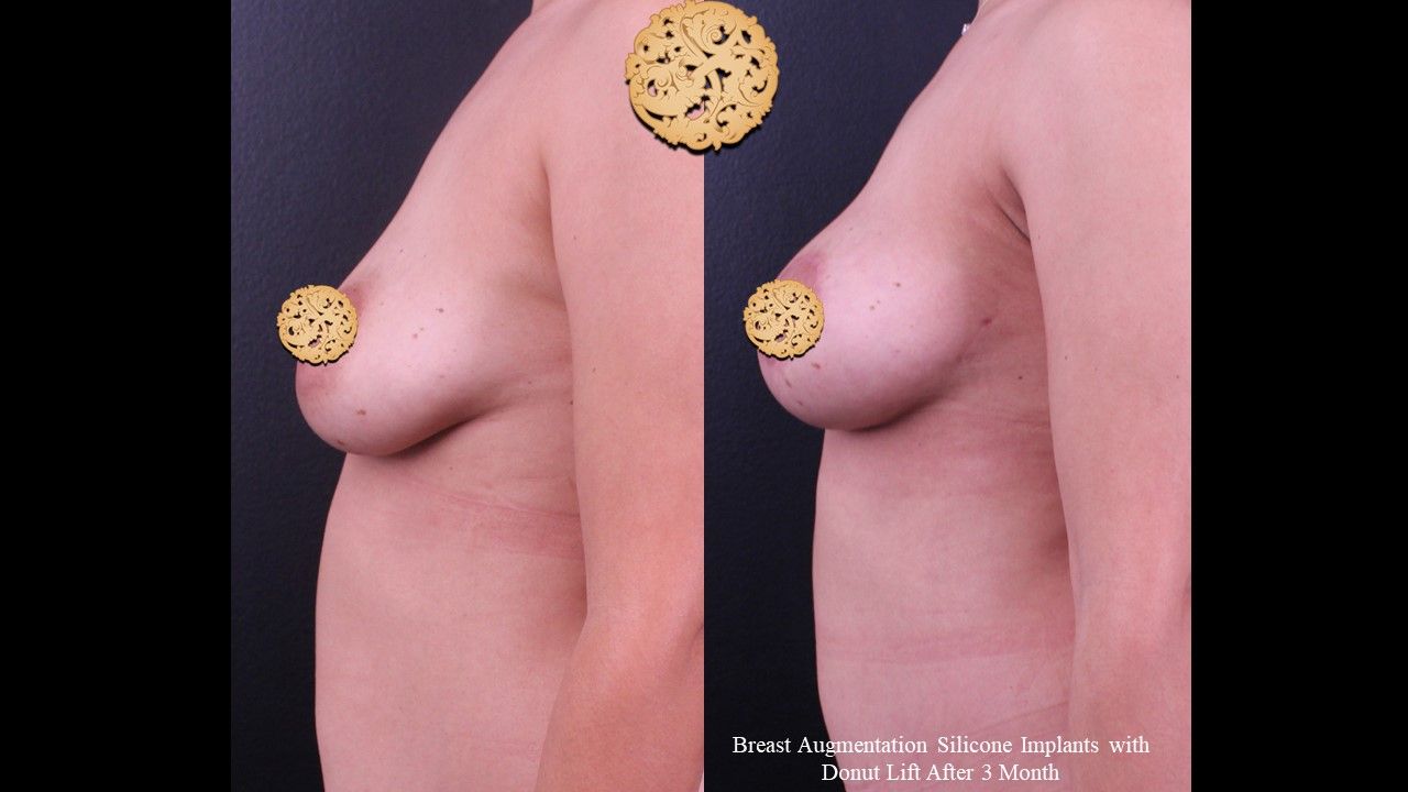 Breast Augmentation With Lift Before & After