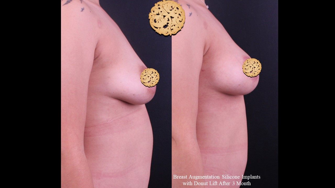 Breast Augmentation With Lift Before & After