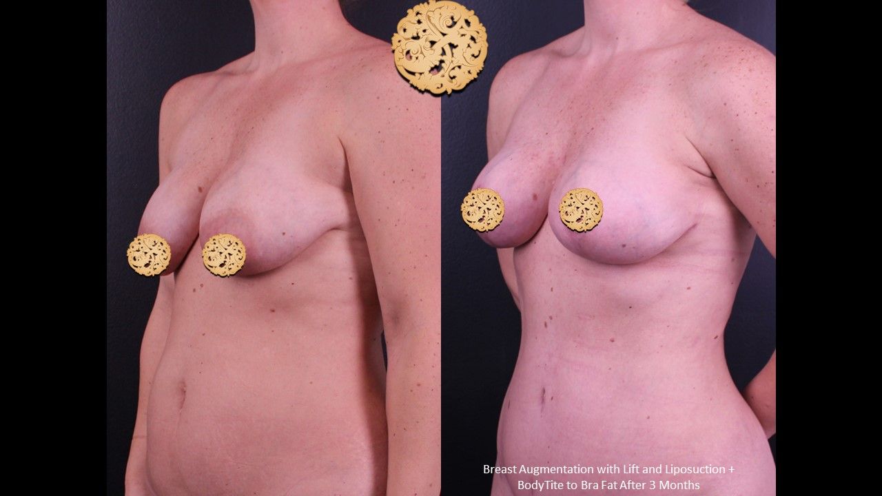 Breast Augmentation With Lift Before & After