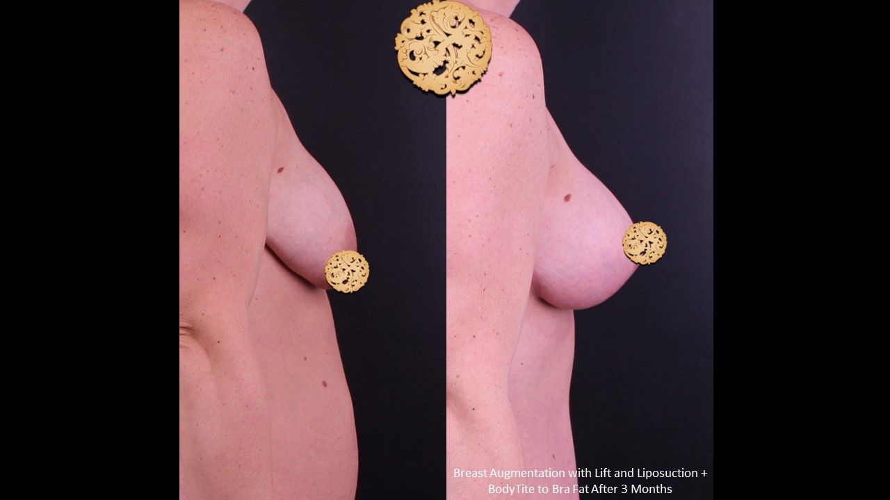 Breast Augmentation With Lift Before & After