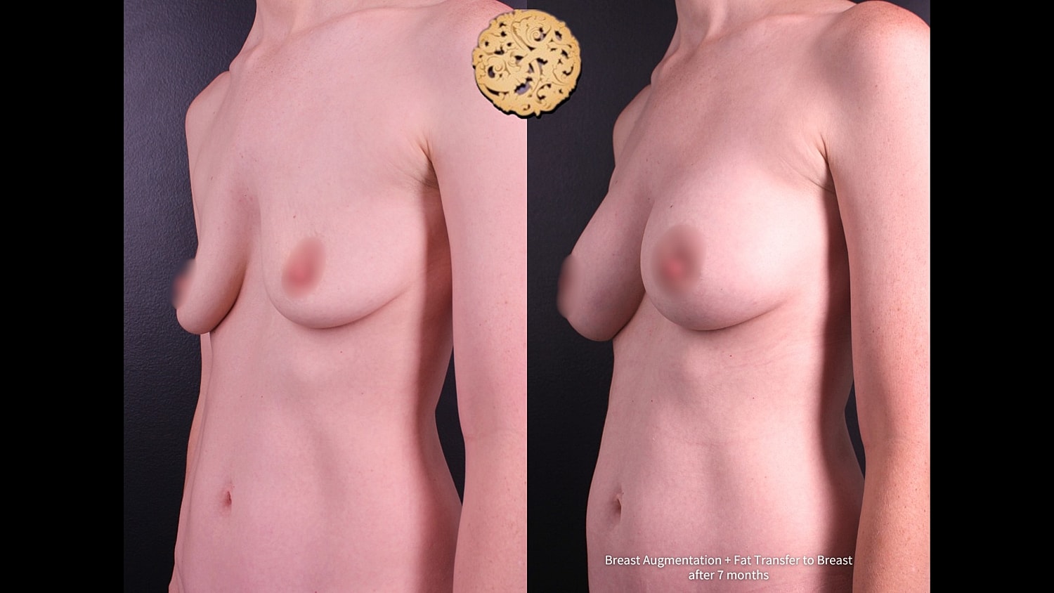 Breast augmentation results, before and after photos.