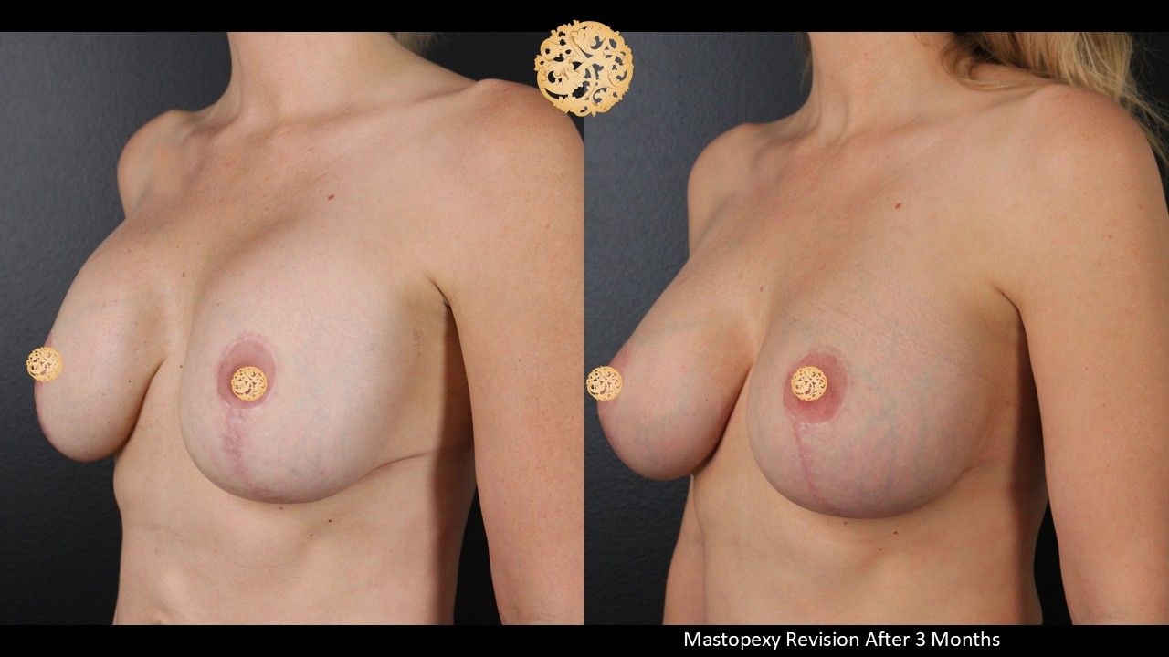 Breast Augmentation With Lift Before & After