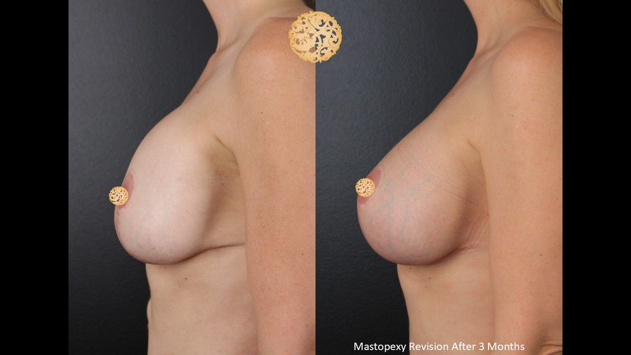 Breast Augmentation With Lift Before & After