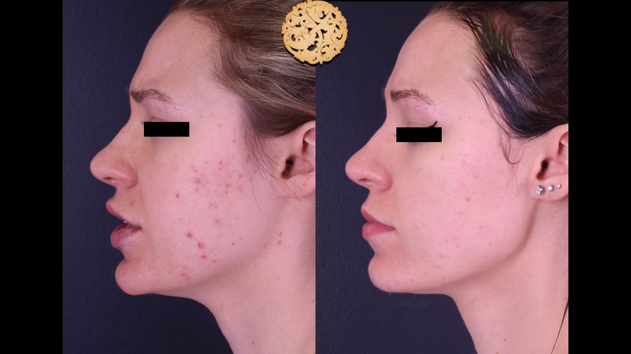 Acne Before & After