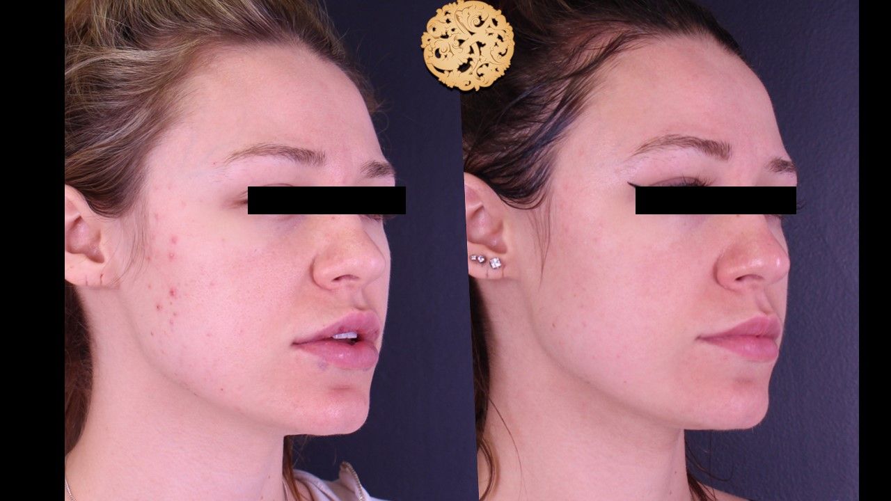 Acne Before & After