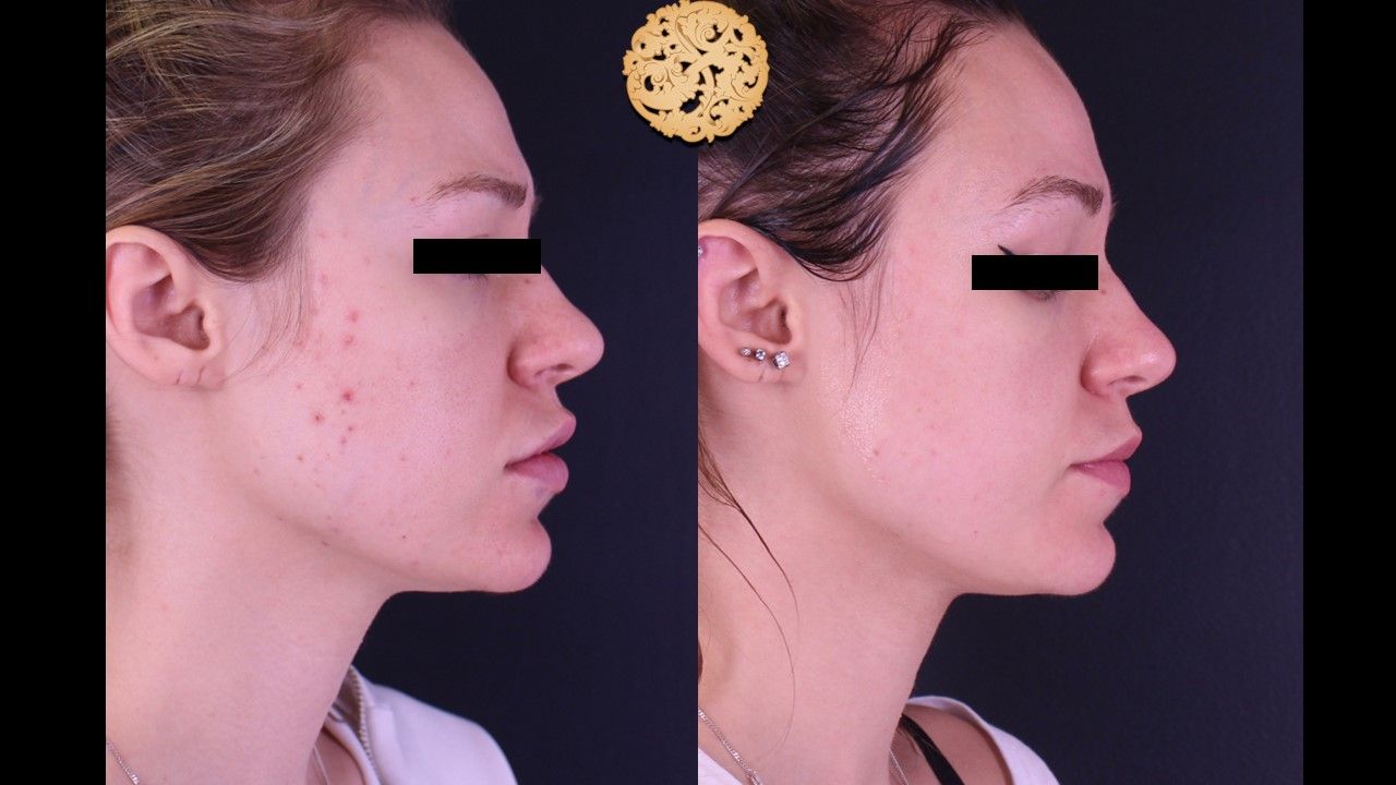 Acne Before & After