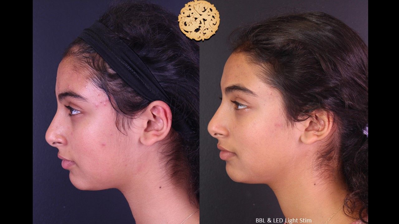 Acne Before & After