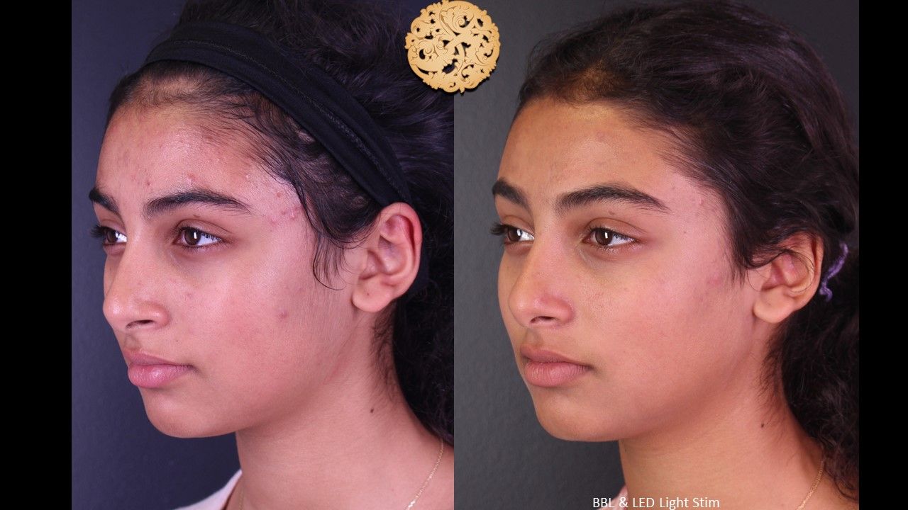 Acne Before & After