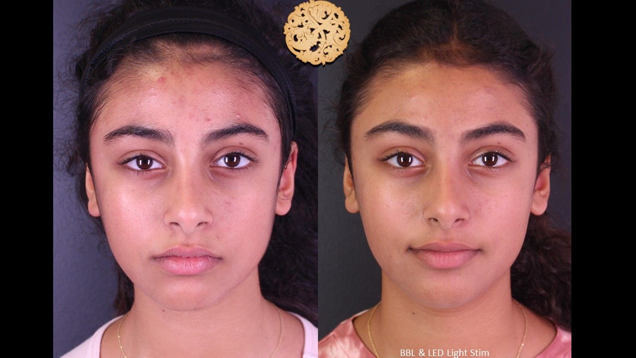 Acne Before & After