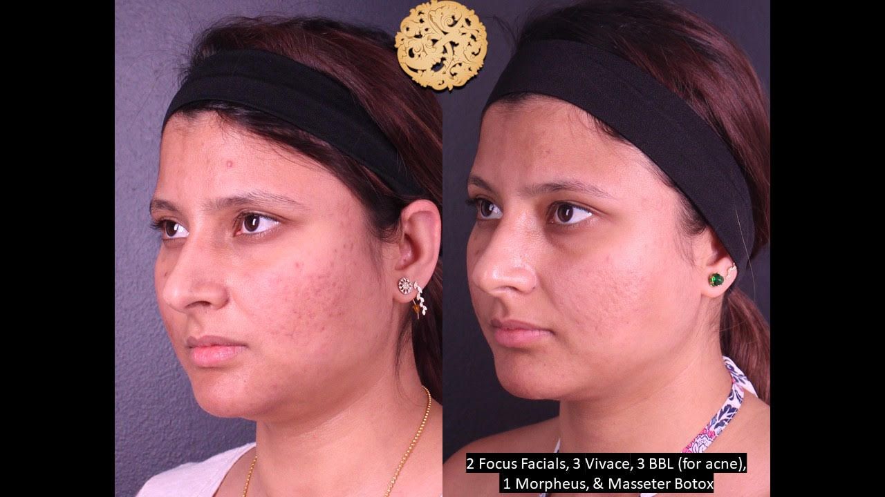 Acne Before & After