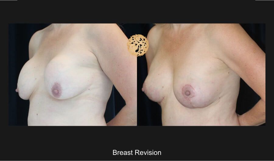 Breast Revision Before & After