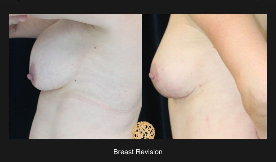 Breast Revision Before & After
