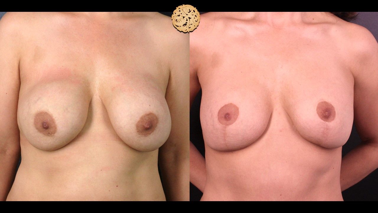 Breast Revision Before & After