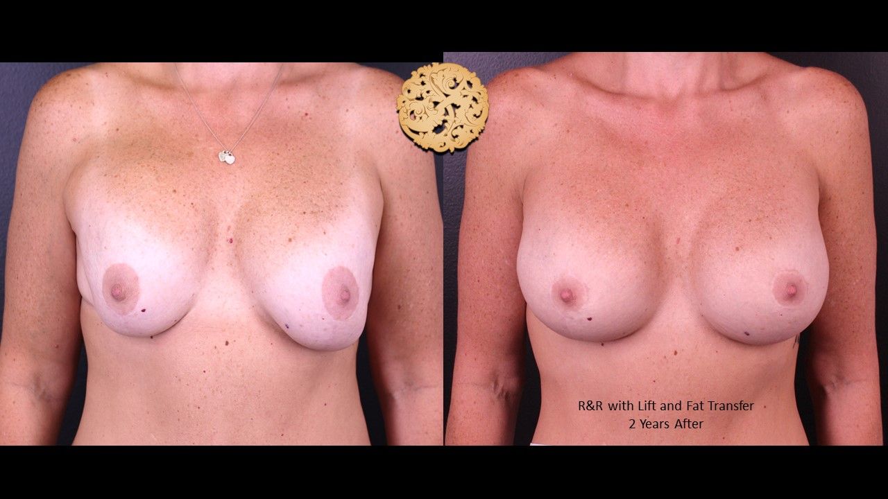 Breast Revision Before & After