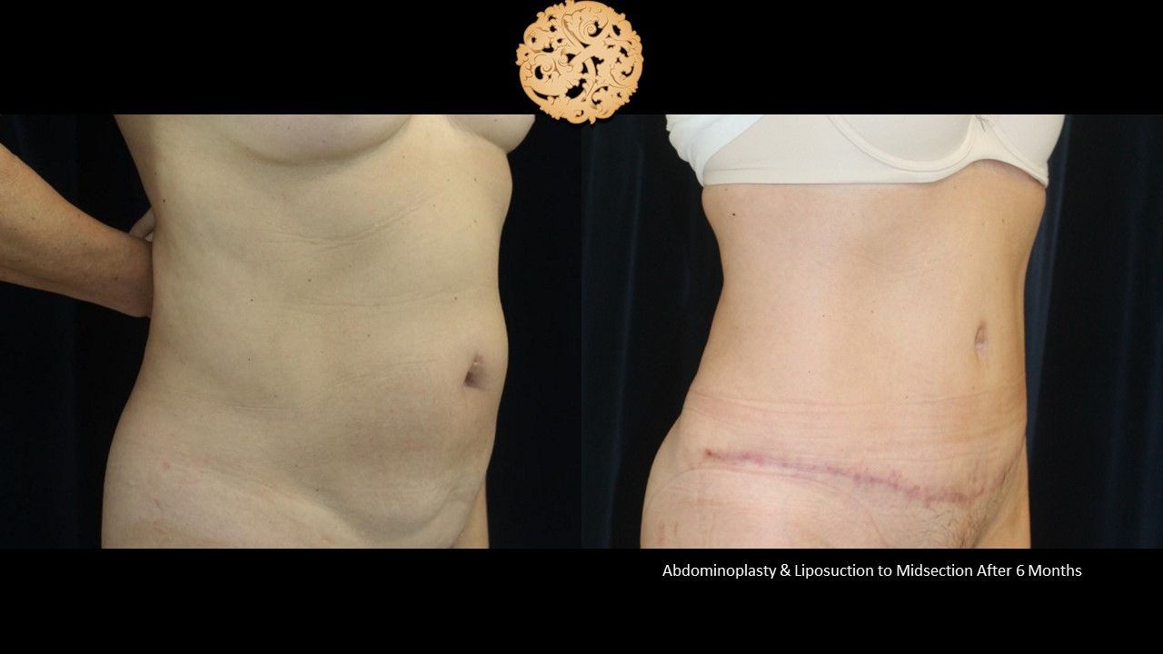 Tummy Tuck Before & After