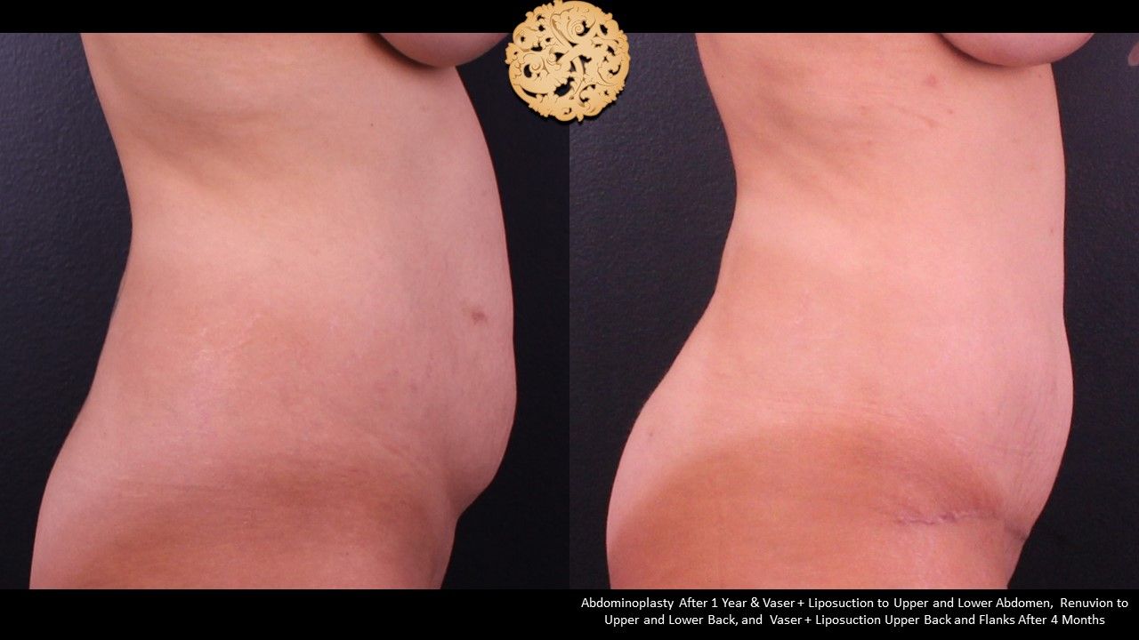 Tummy Tuck Before & After