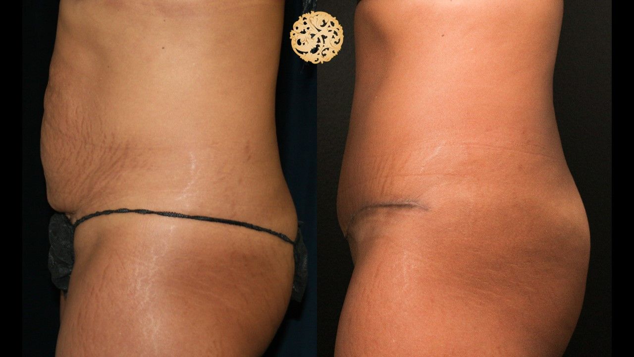 Tummy Tuck Before & After