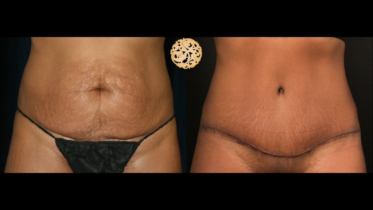 Tummy Tuck Before & After