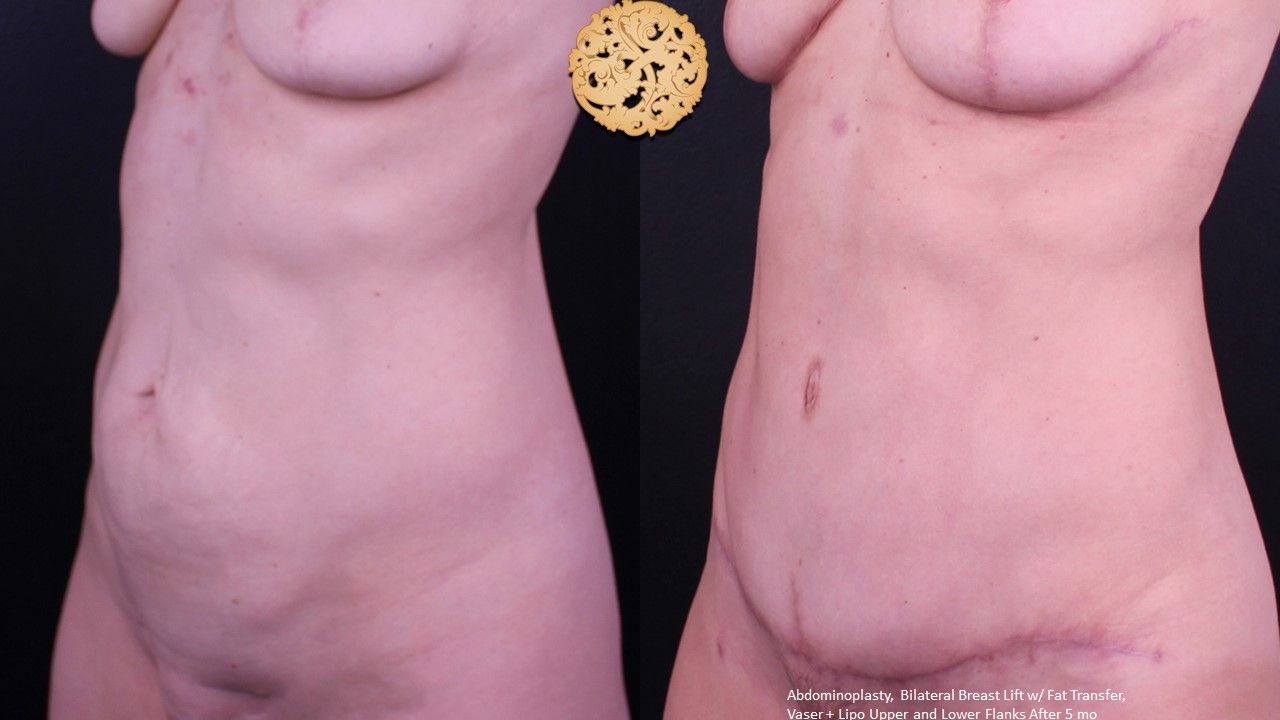 Tummy Tuck Before & After