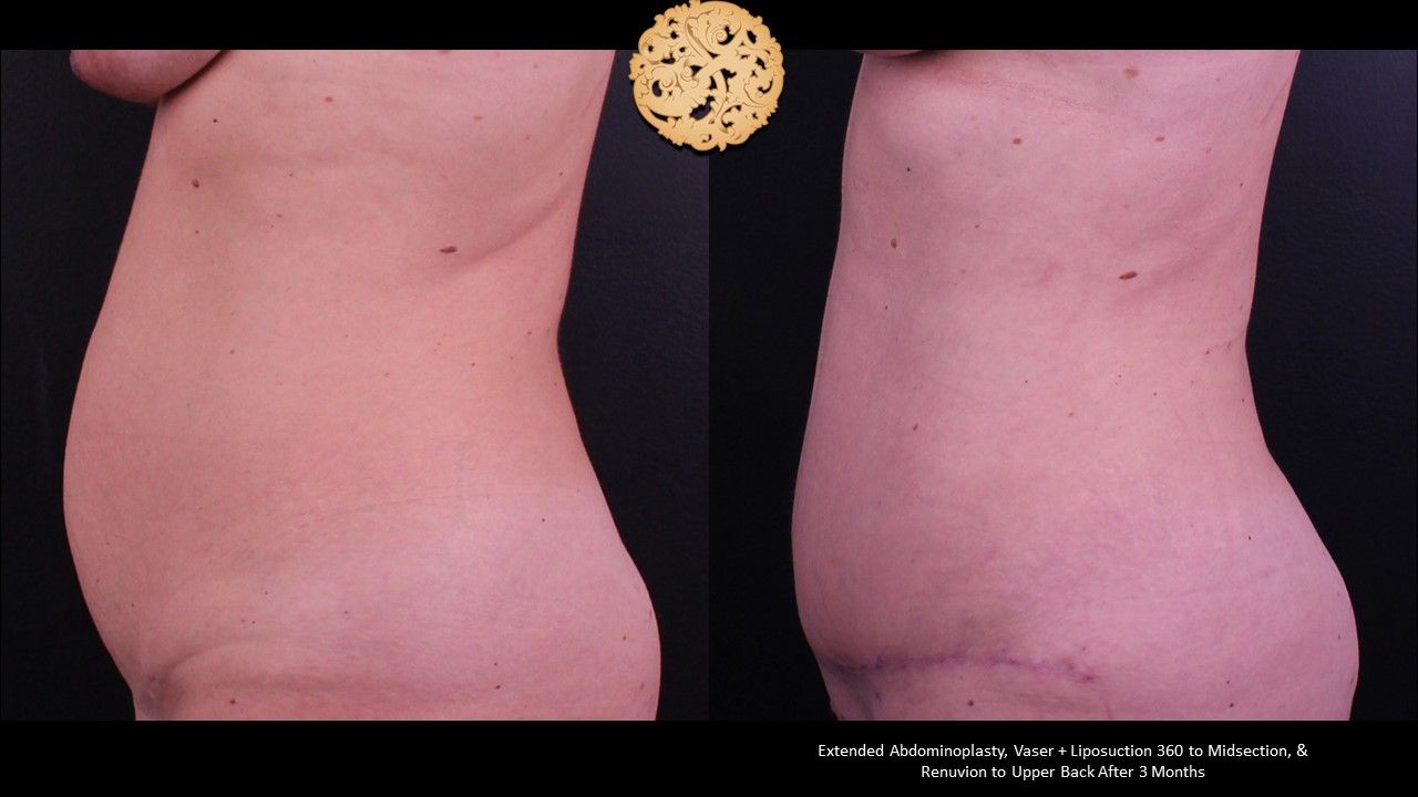 Tummy Tuck Before & After