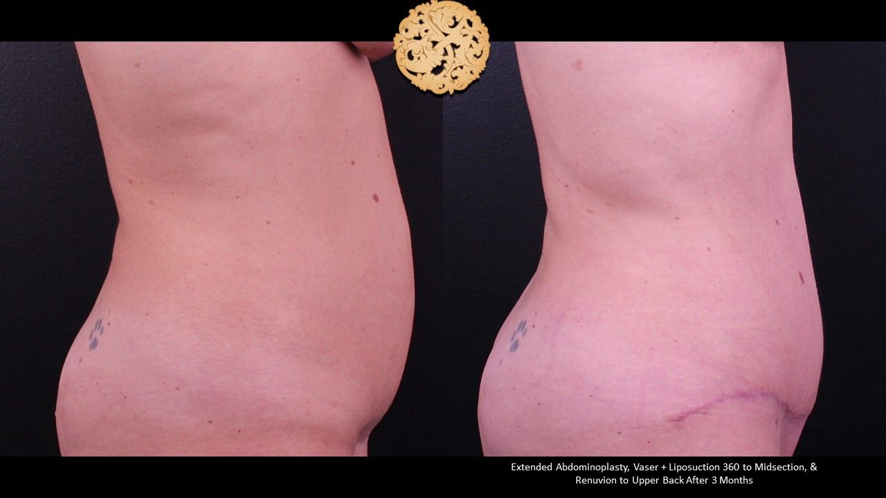 Tummy Tuck Before & After