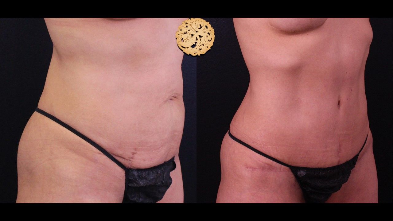 Tummy Tuck Before & After
