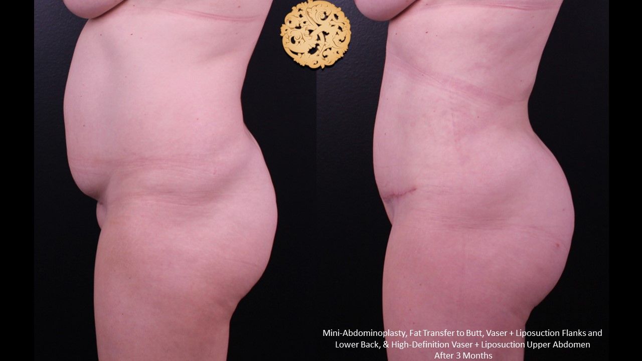 Tummy Tuck Before & After