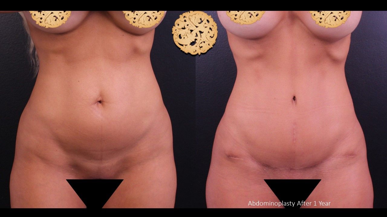 Tummy Tuck Before & After