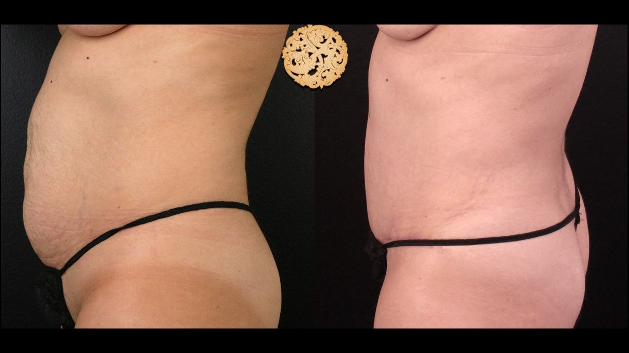 Tummy Tuck Before & After