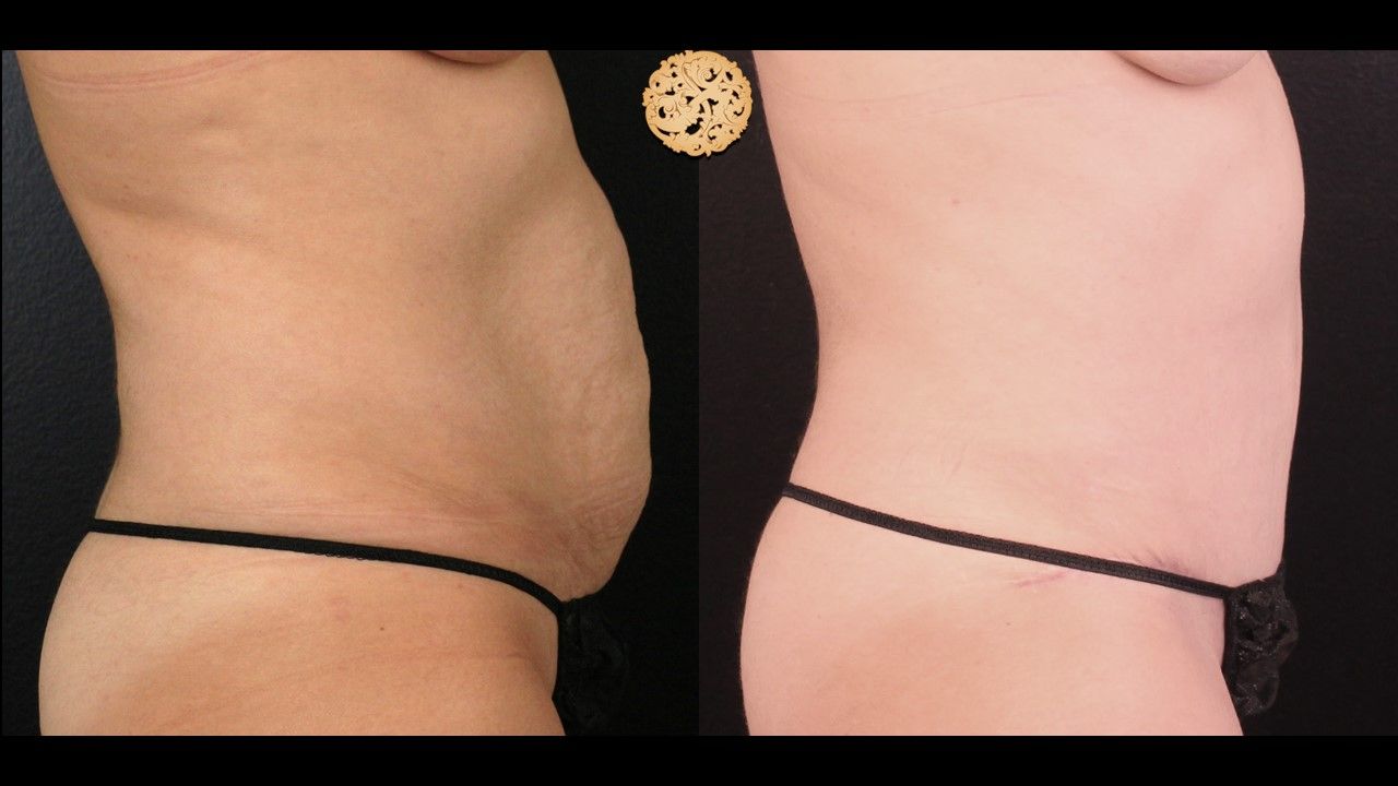Tummy Tuck Before & After