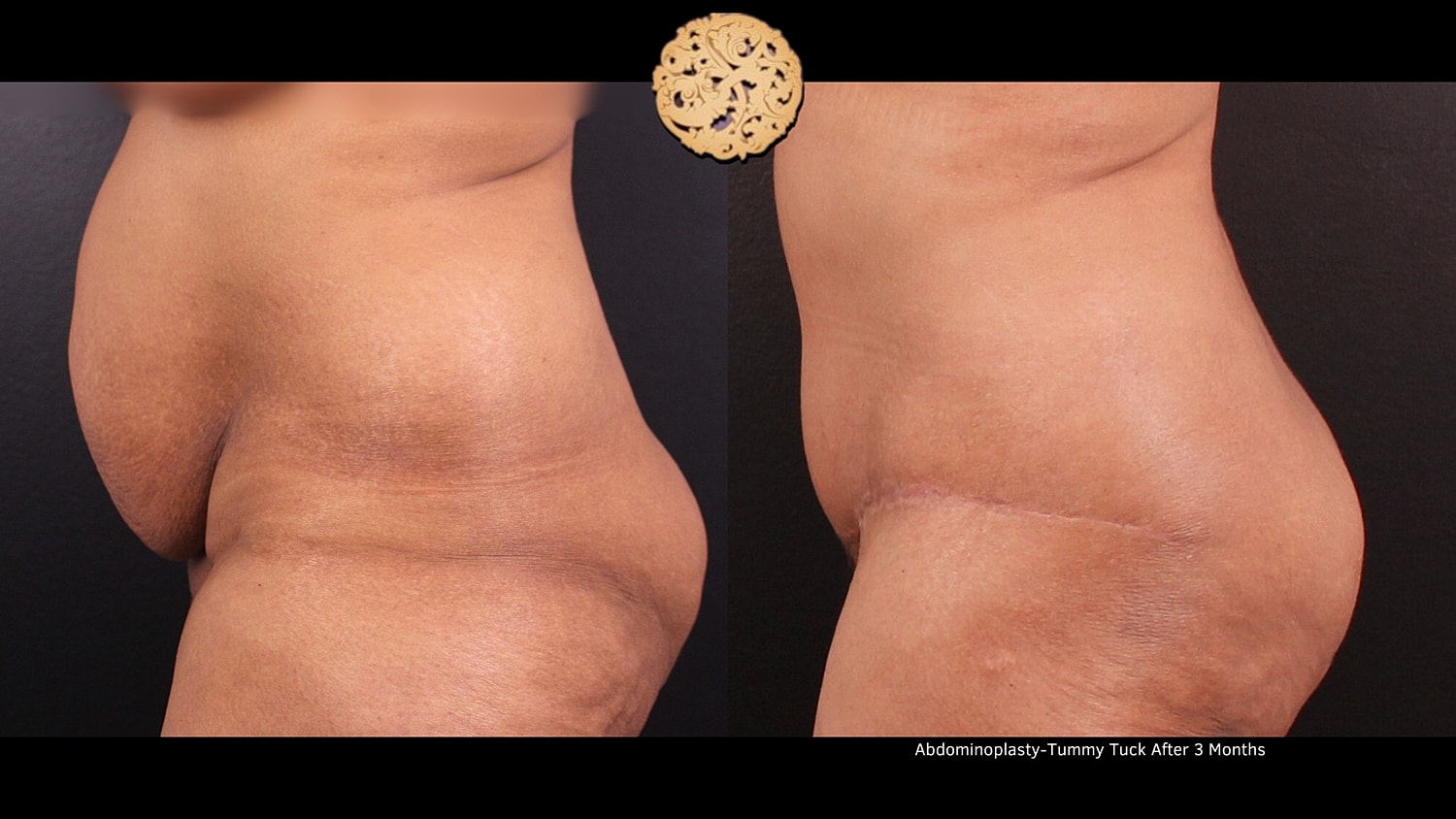 Tummy Tuck Before & After