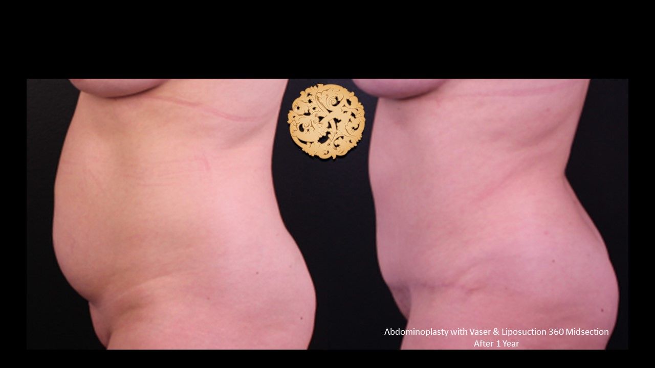 Tummy Tuck Before & After