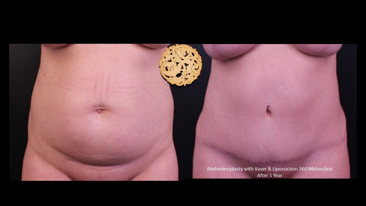 Tummy Tuck Before & After