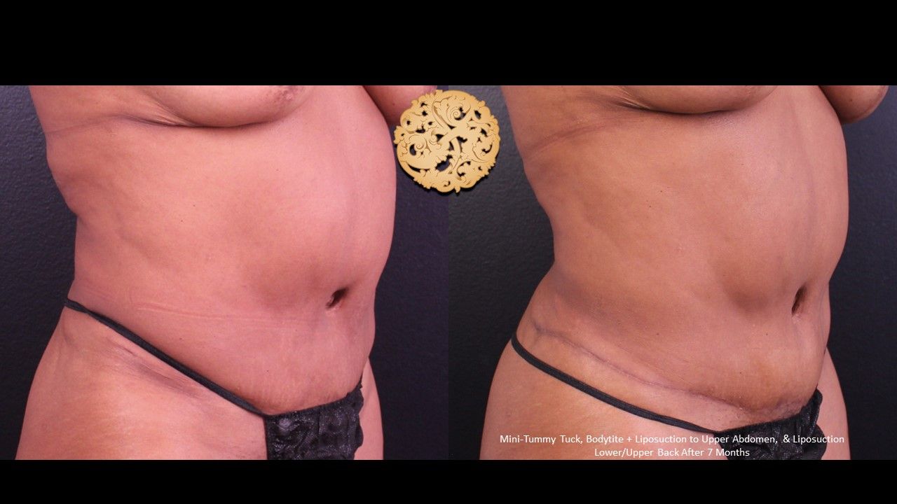 Tummy Tuck Before & After