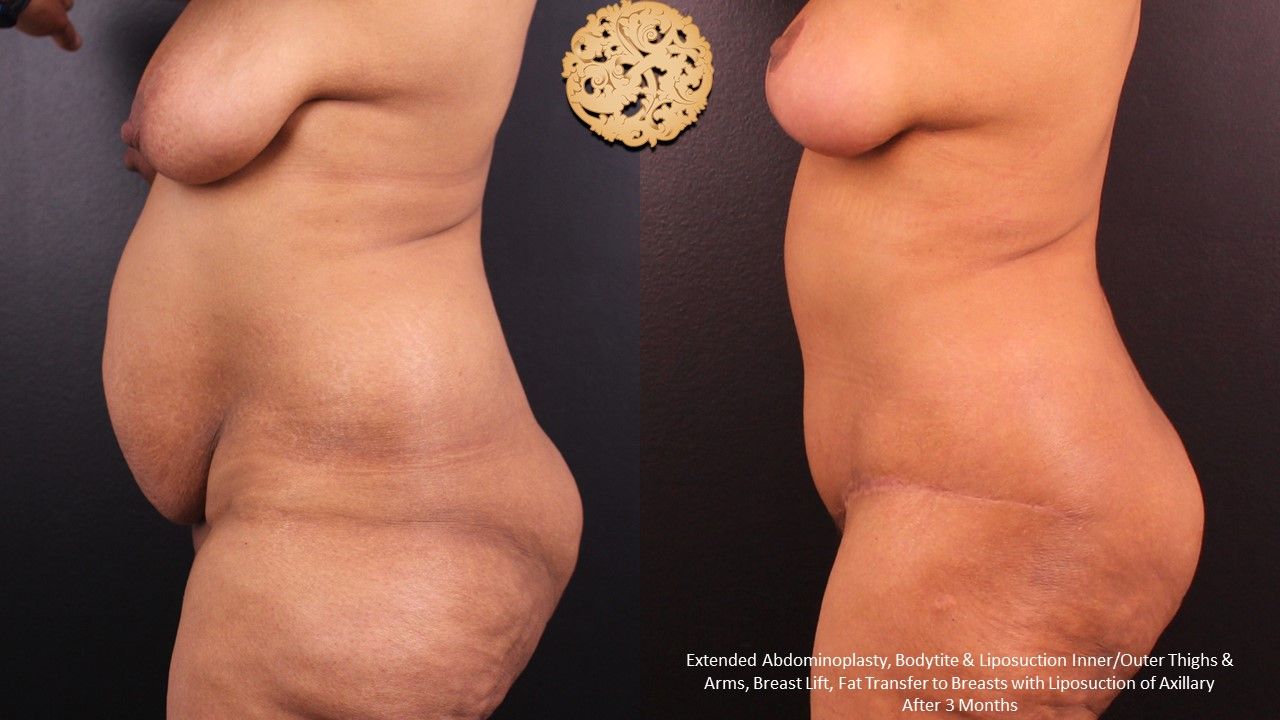 Tummy Tuck Before & After