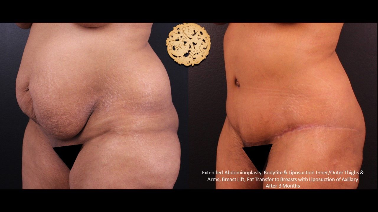 Tummy Tuck Before & After