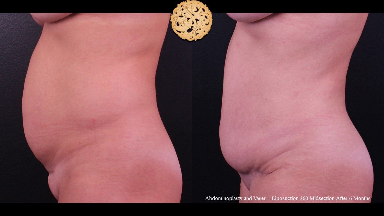 Tummy Tuck Before & After