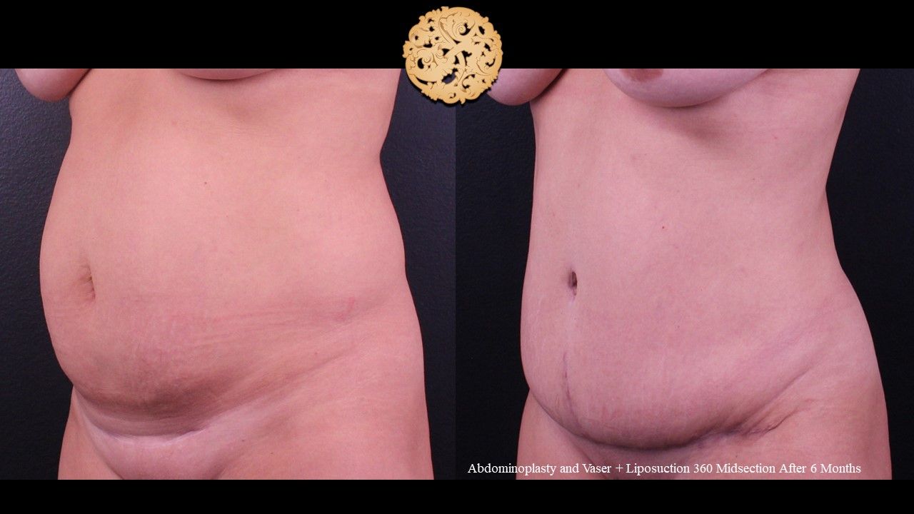 Tummy Tuck Before & After