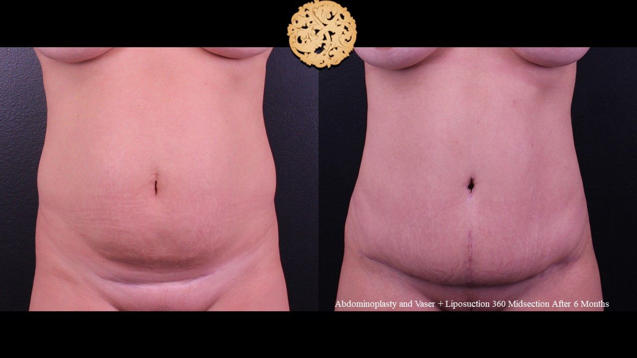 Tummy Tuck Before & After
