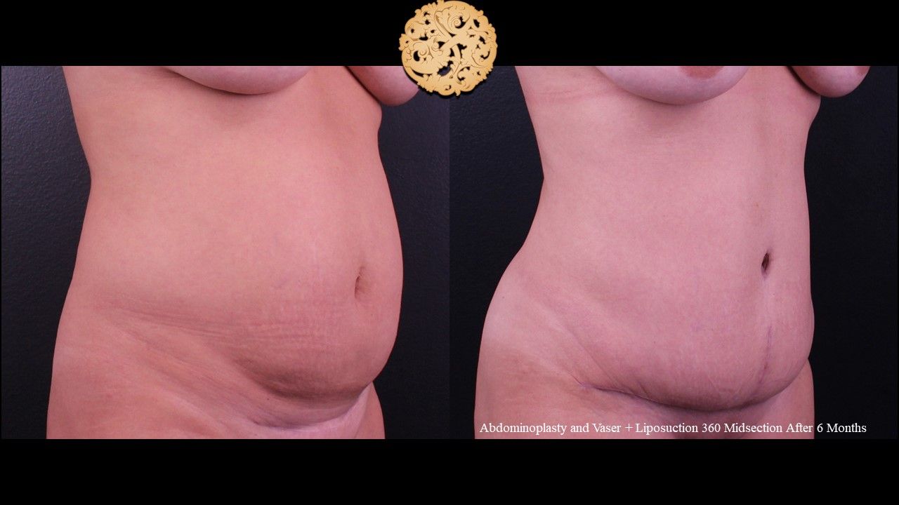 Tummy Tuck Before & After
