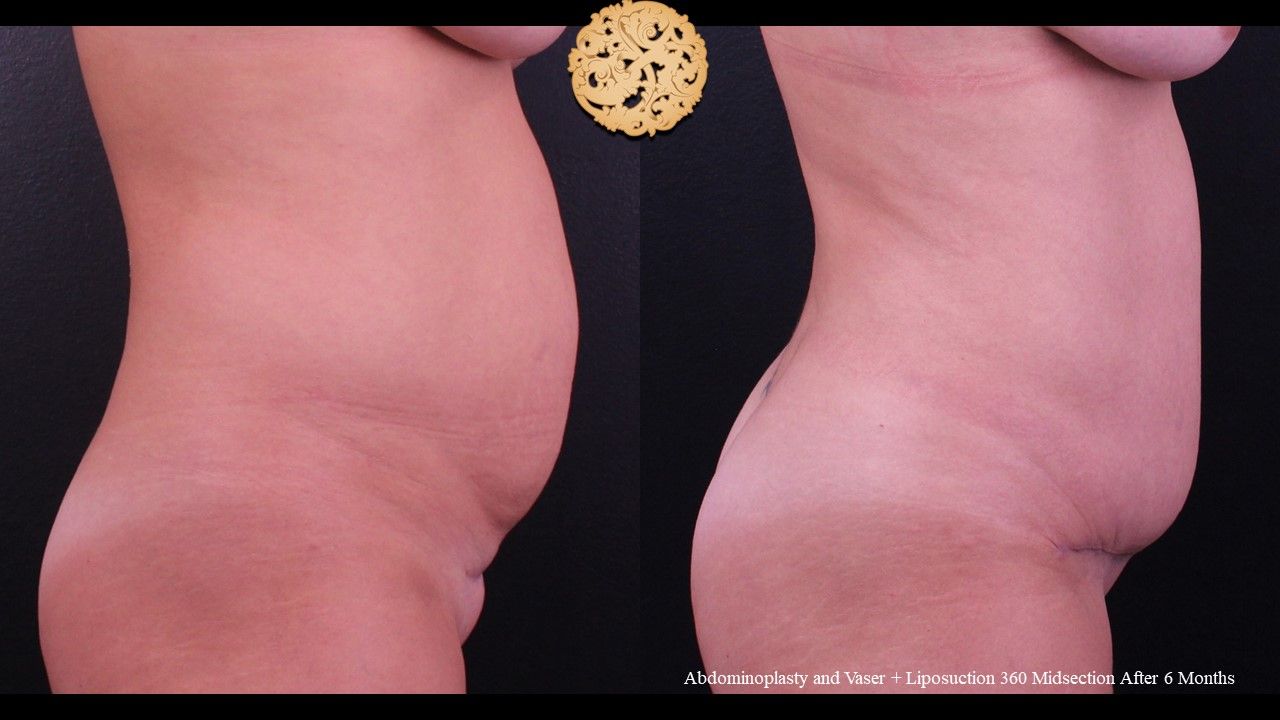 Tummy Tuck Before & After