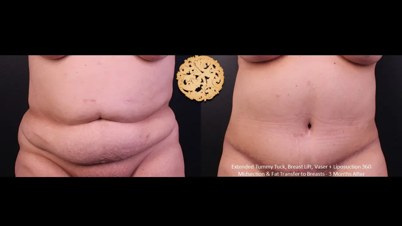Tummy Tuck Before & After