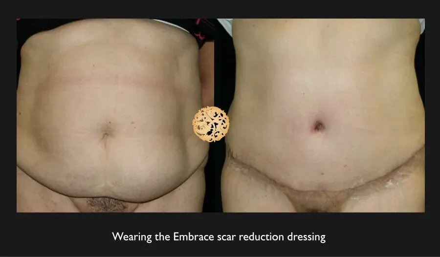 Tummy Tuck Before & After