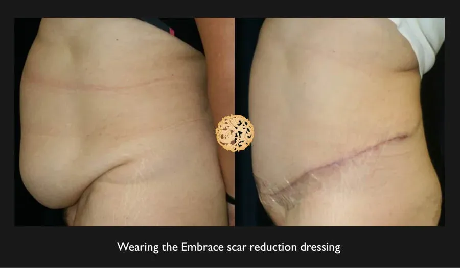 Tummy Tuck Before & After