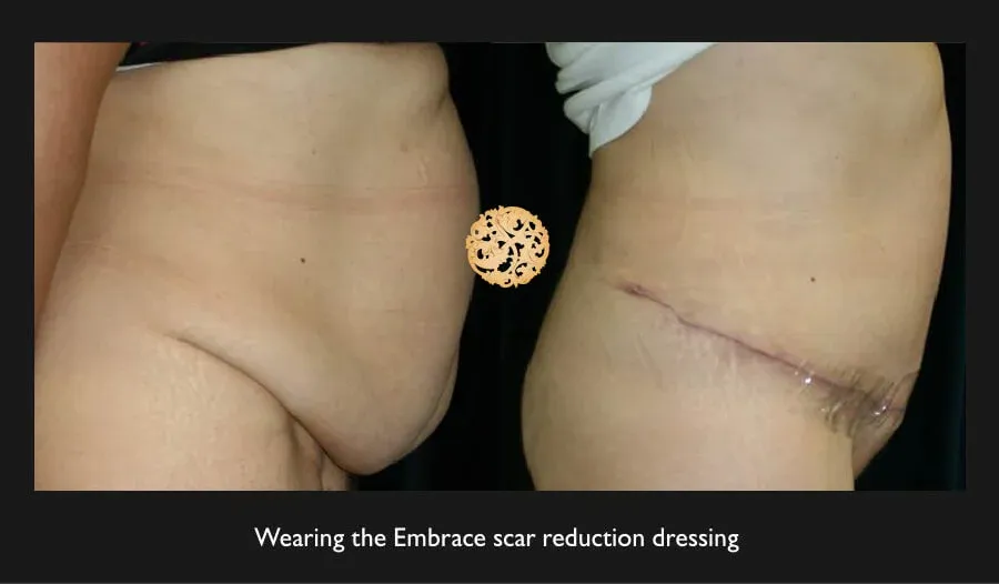 Tummy Tuck Before & After